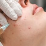 Affordable Acne Treatment in Aligarh You Can Trust Today