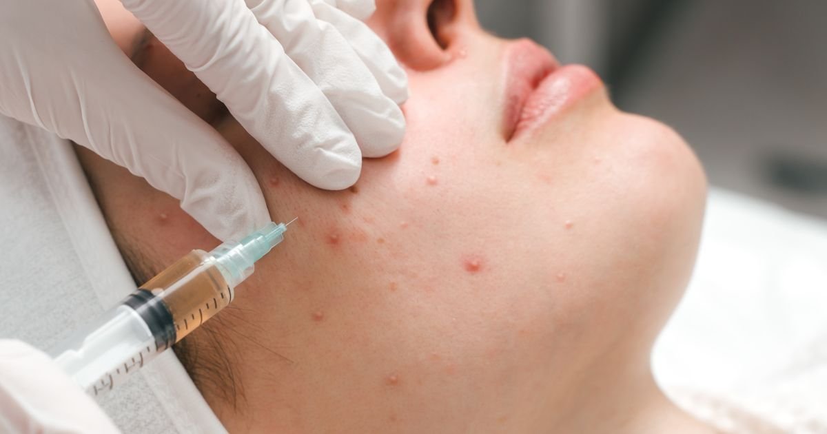 Affordable Acne Treatment in Aligarh You Can Trust Today