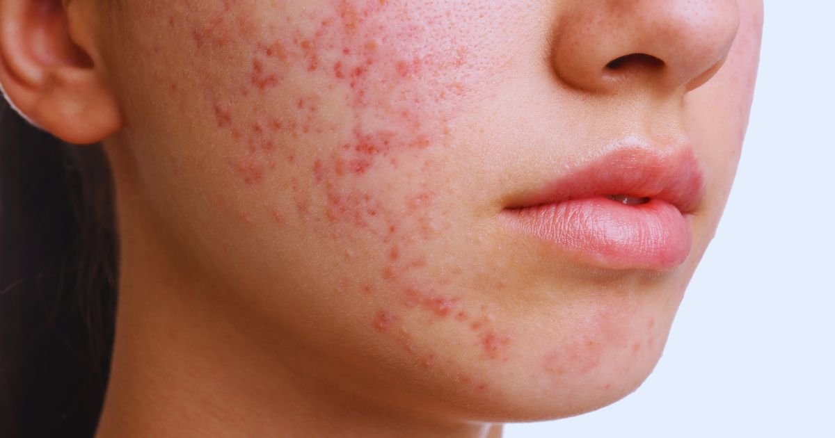 Best Acne Treatment in Aligarh for Clear and Healthy Skin