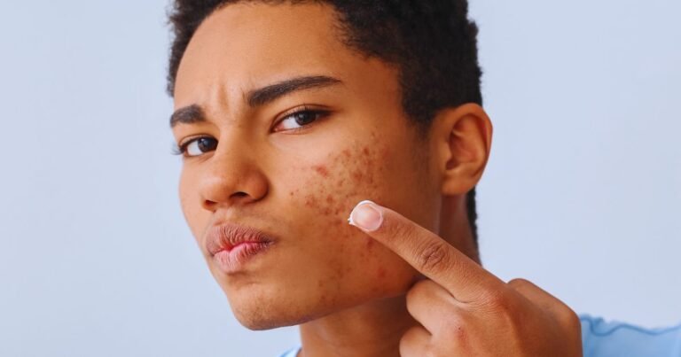Where to Get Acne Treatment in Aligarh for Lasting Results
