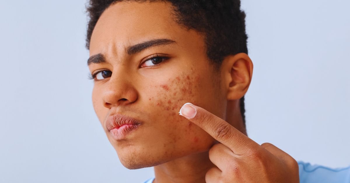 Where to Get Acne Treatment in Aligarh for Lasting Results