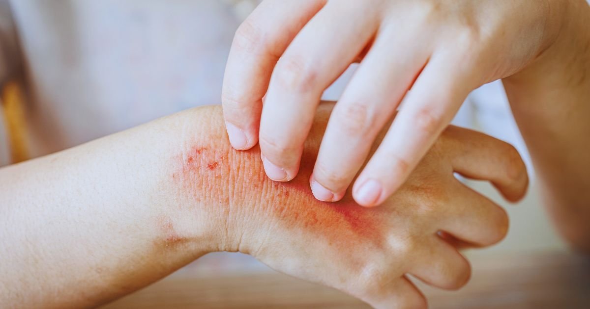 Advanced Skin Allergy Treatment in Aligarh for Lasting Relief