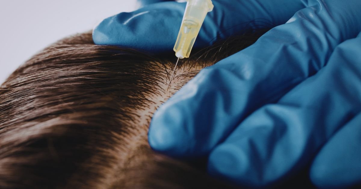 Best Hair Fall Treatment in Aligarh by Skin Specialists