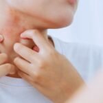 Best Skin Allergy Treatment in Aligarh for Quick Relief