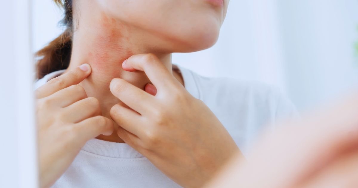 Best Skin Allergy Treatment in Aligarh for Quick Relief