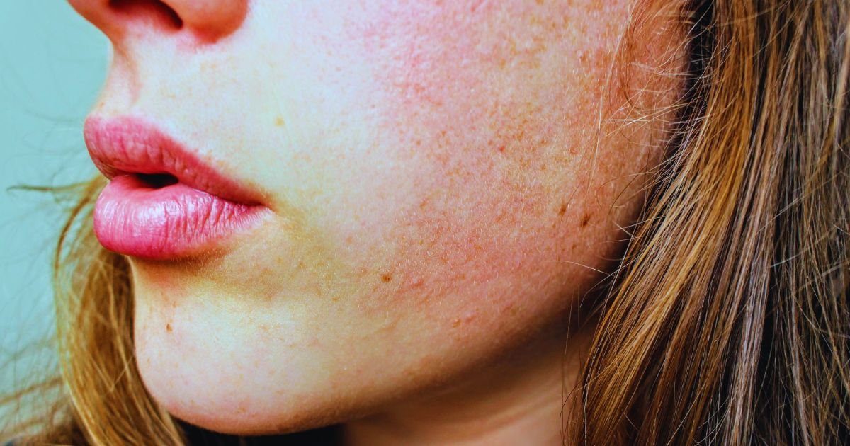 Effective Skin Allergy Treatment in Aligarh for Healthy Skin