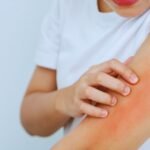 Skin Allergy Treatment in Aligarh by Expert Doctors