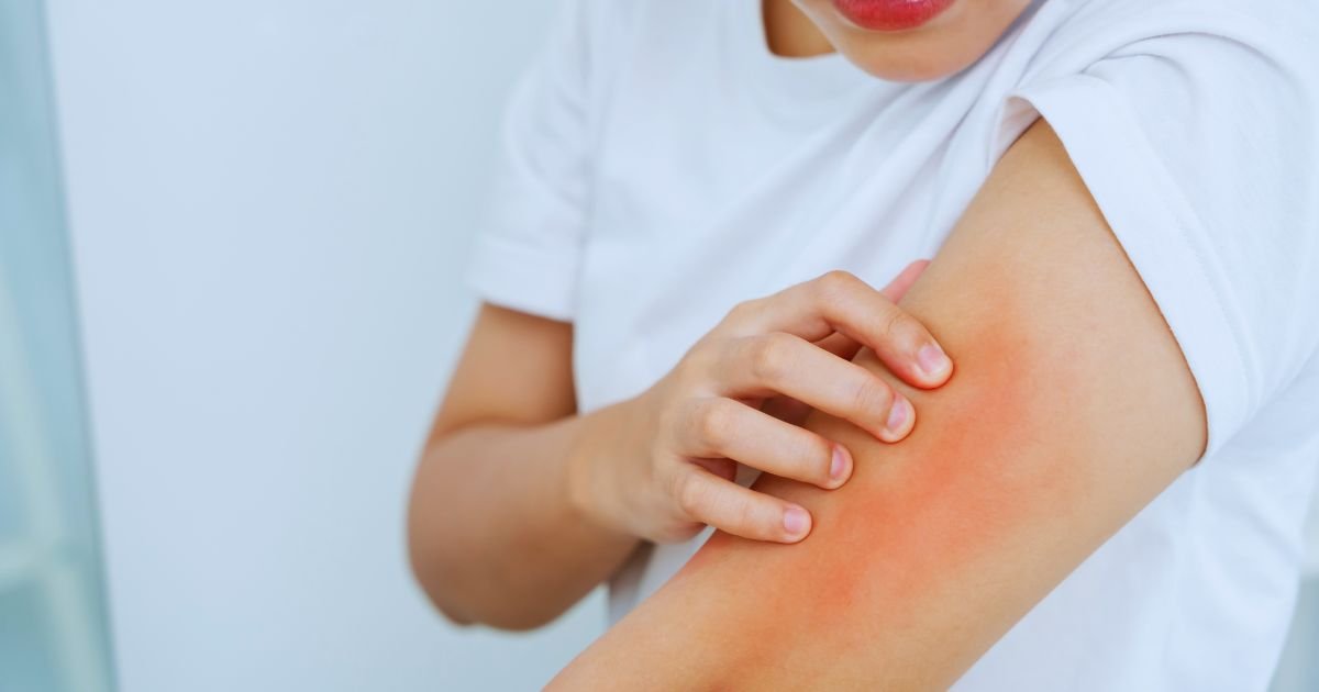 Skin Allergy Treatment in Aligarh by Expert Doctors
