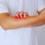 Where to Get Itchy Skin Treatment in Aligarh Safely