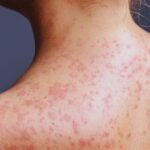 Varun Skin Solutions - Acne Treatment in Aligarh: Causes, Care, and Solutions