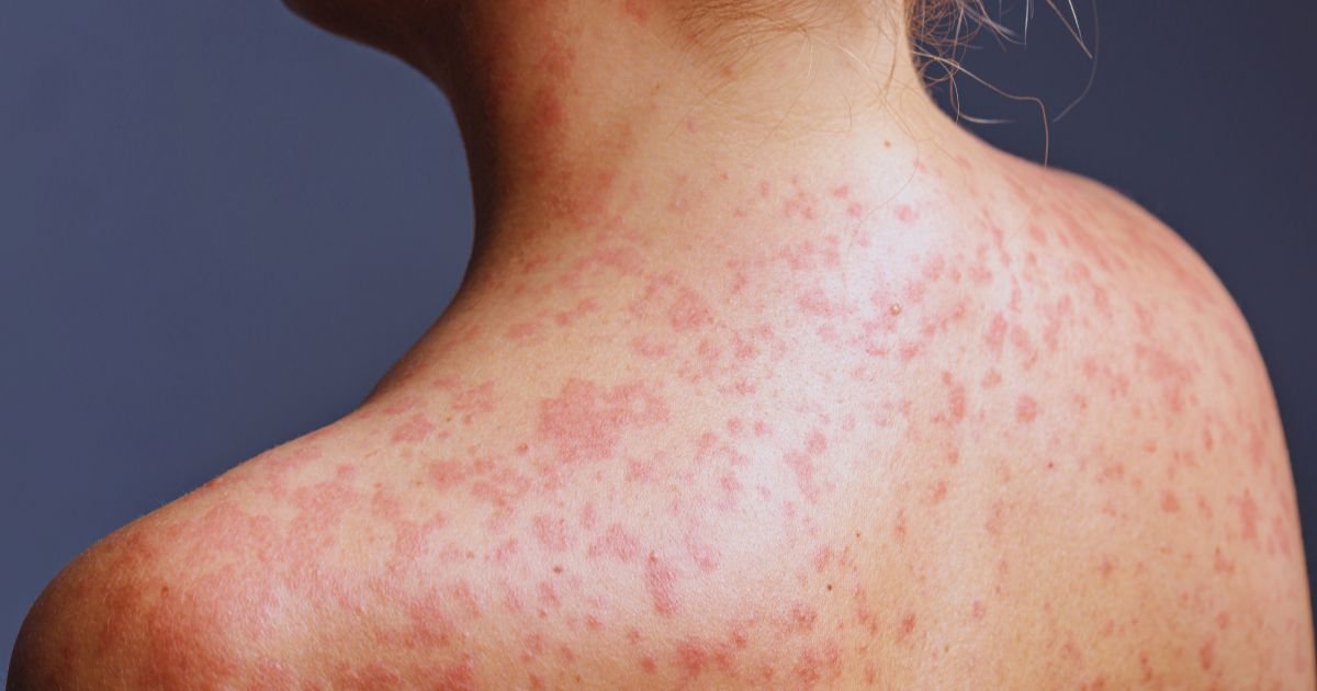 Varun Skin Solutions - Acne Treatment in Aligarh: Causes, Care, and Solutions