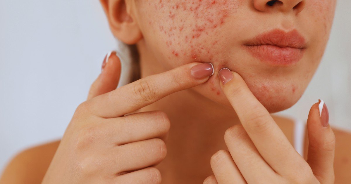 Varun Skin Solutions - Best Acne Treatment in Aligarh by Skin Specialists