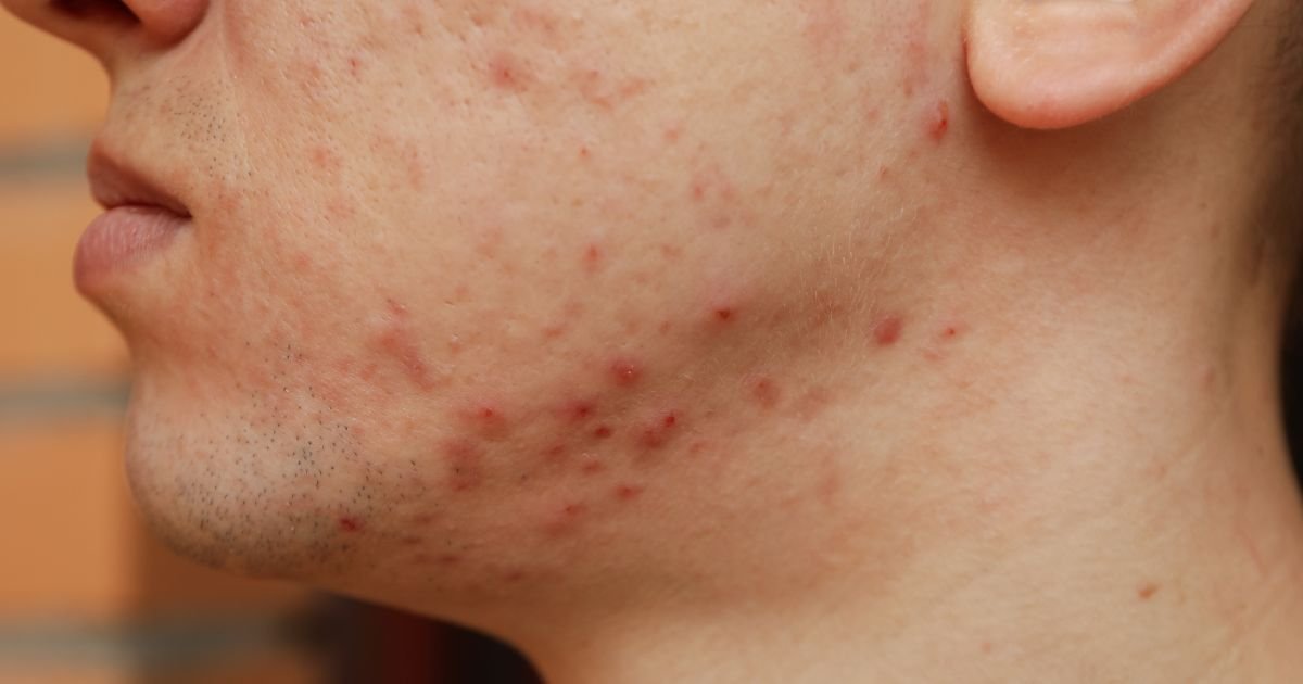 Varun Skin Solutions - Where to Get Acne Treatment in Aligarh from Experts