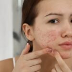 Varun Skin Solutions - Allergy Rashes Treatment in Aligarh for Healthy Skin