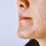 Varun Skin Solutions - Best Allergy Rashes Treatment in Aligarh by Experts