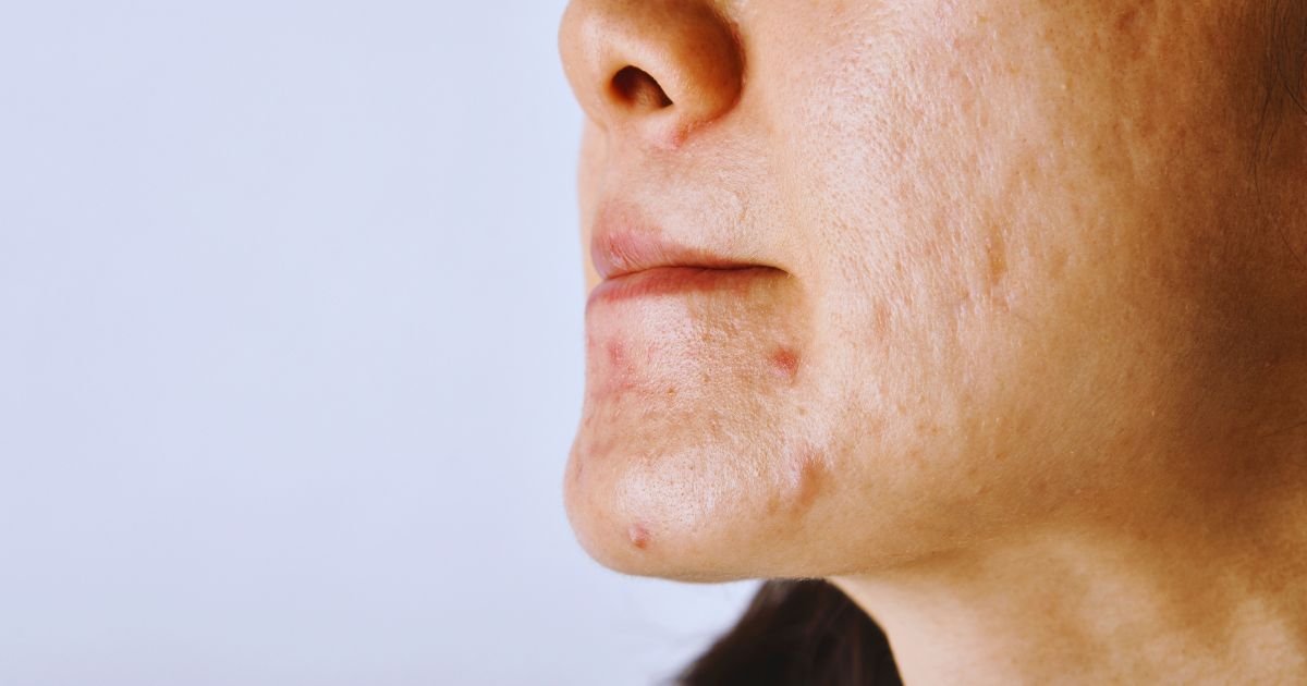 Varun Skin Solutions - Best Allergy Rashes Treatment in Aligarh by Experts
