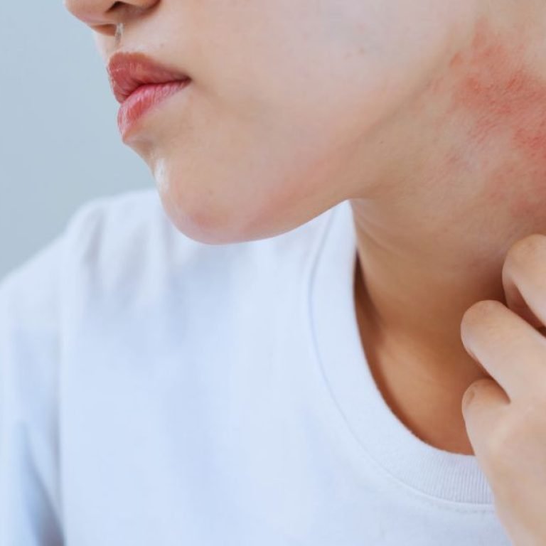 Advanced Itchy Skin Treatment in Aligarh for Skin Health