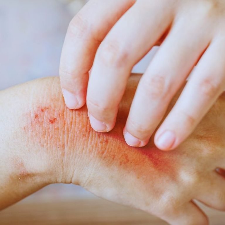 Advanced Skin Allergy Treatment in Aligarh for Lasting Relief