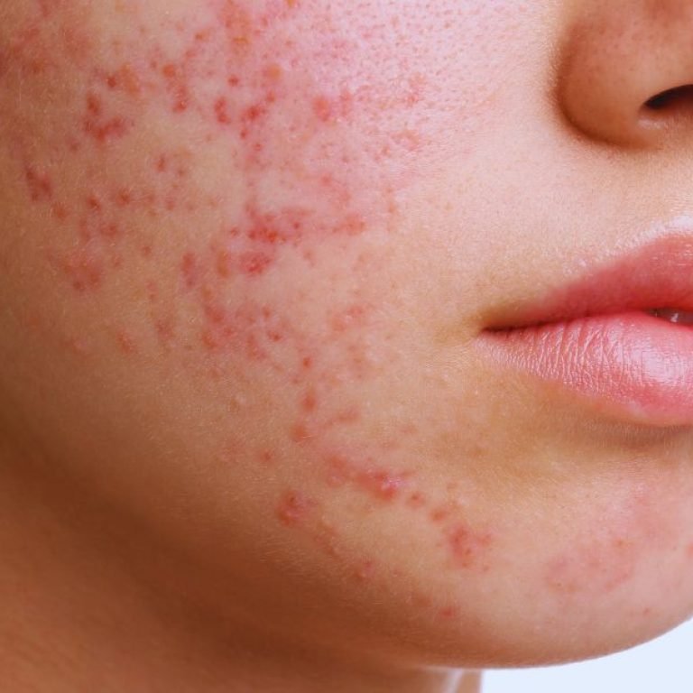 Best Acne Treatment in Aligarh for Clear and Healthy Skin