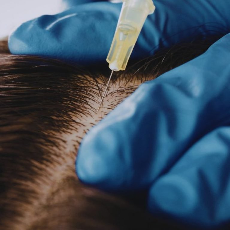 Best Hair Fall Treatment in Aligarh by Skin Specialists