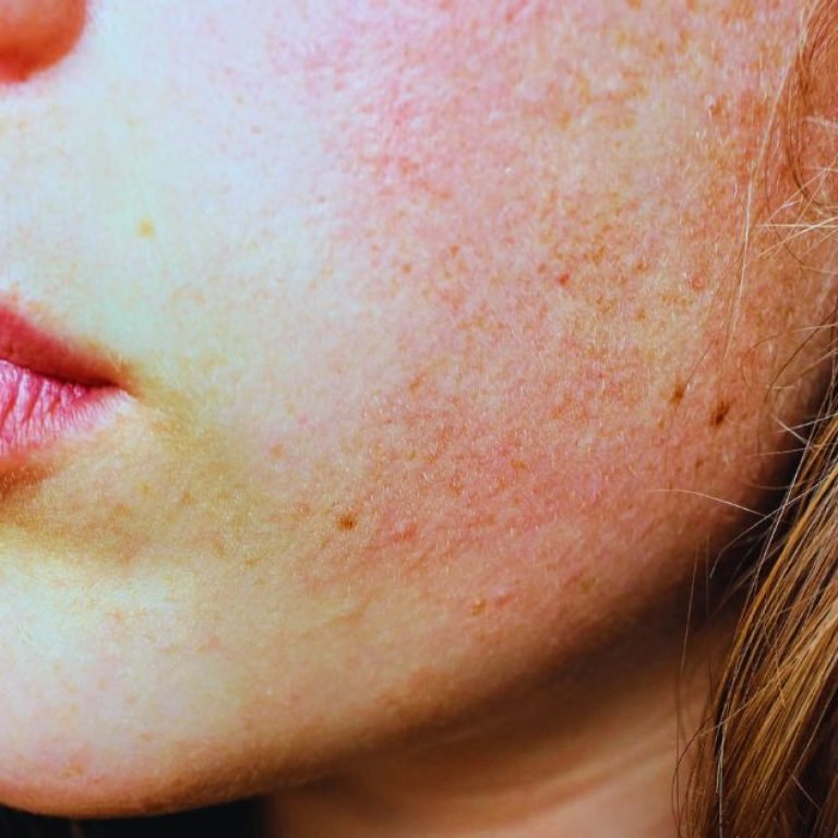 Effective Skin Allergy Treatment in Aligarh for Healthy Skin