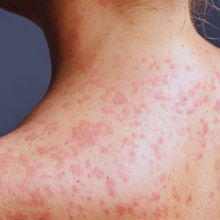 Varun Skin Solutions - Acne Treatment in Aligarh: Causes, Care, and Solutions