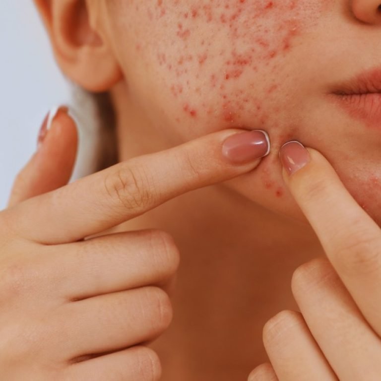 Varun Skin Solutions - Best Acne Treatment in Aligarh by Skin Specialists
