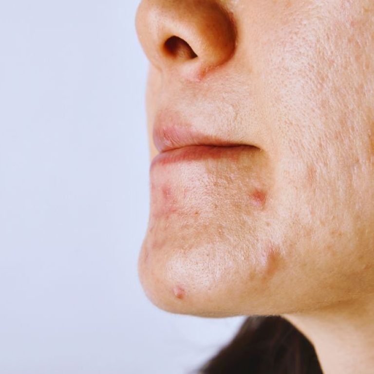 Varun Skin Solutions - Best Allergy Rashes Treatment in Aligarh by Experts