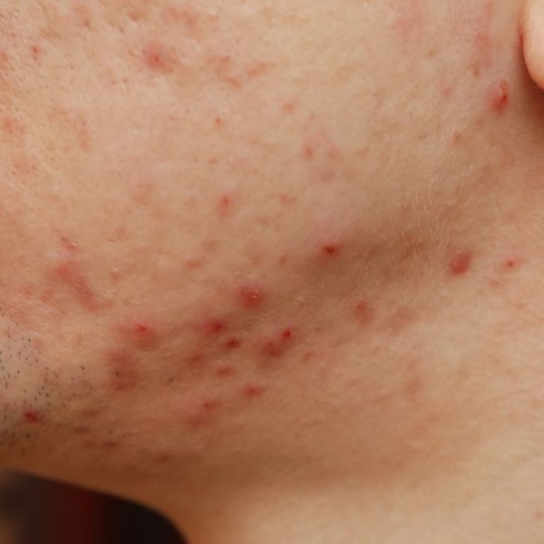 Varun Skin Solutions - Where to Get Acne Treatment in Aligarh from Experts