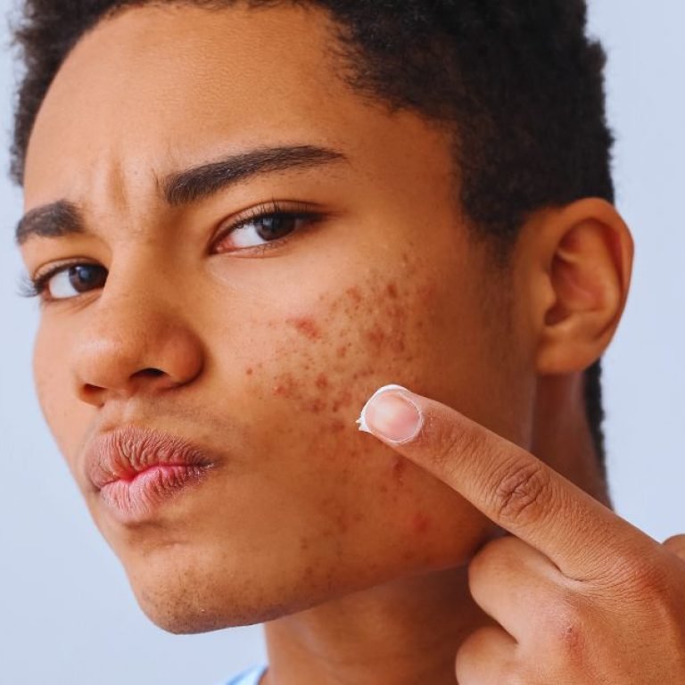 Where to Get Acne Treatment in Aligarh for Lasting Results